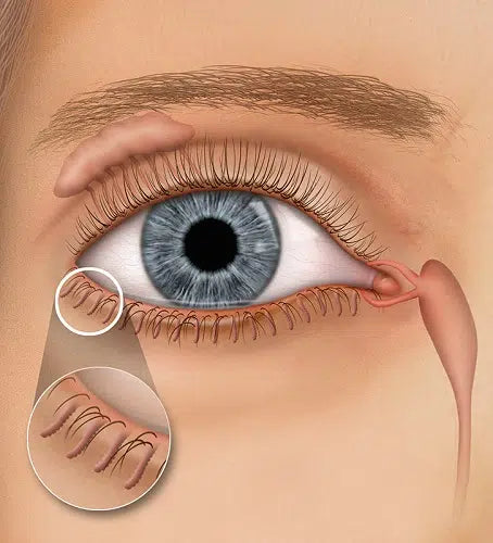 Meibomian Gland Dysfunction (MGD): What Is It and How Can You Treat It?